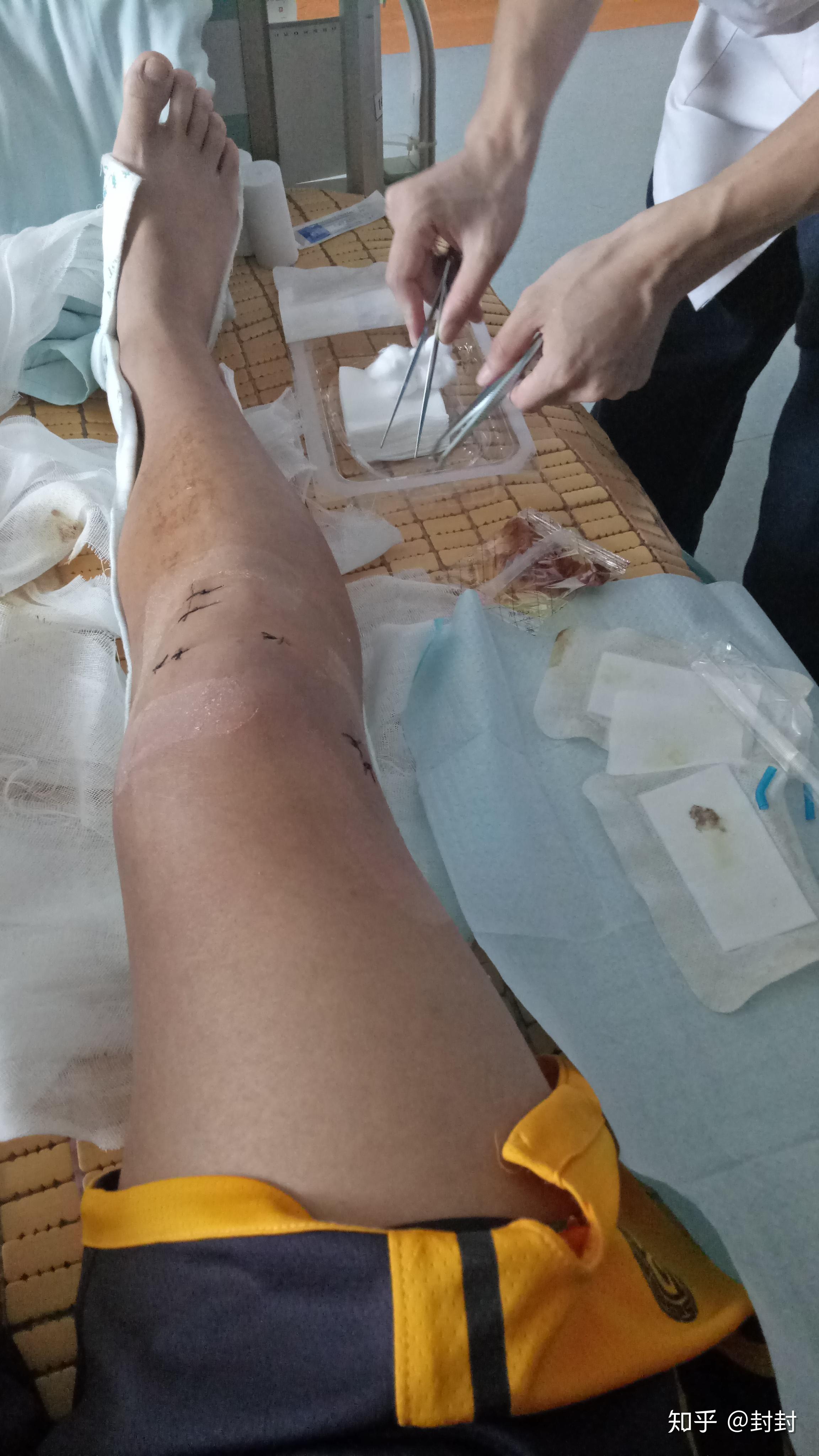膝盖前交叉韧带断裂是一种什么样的体验? - 知乎
