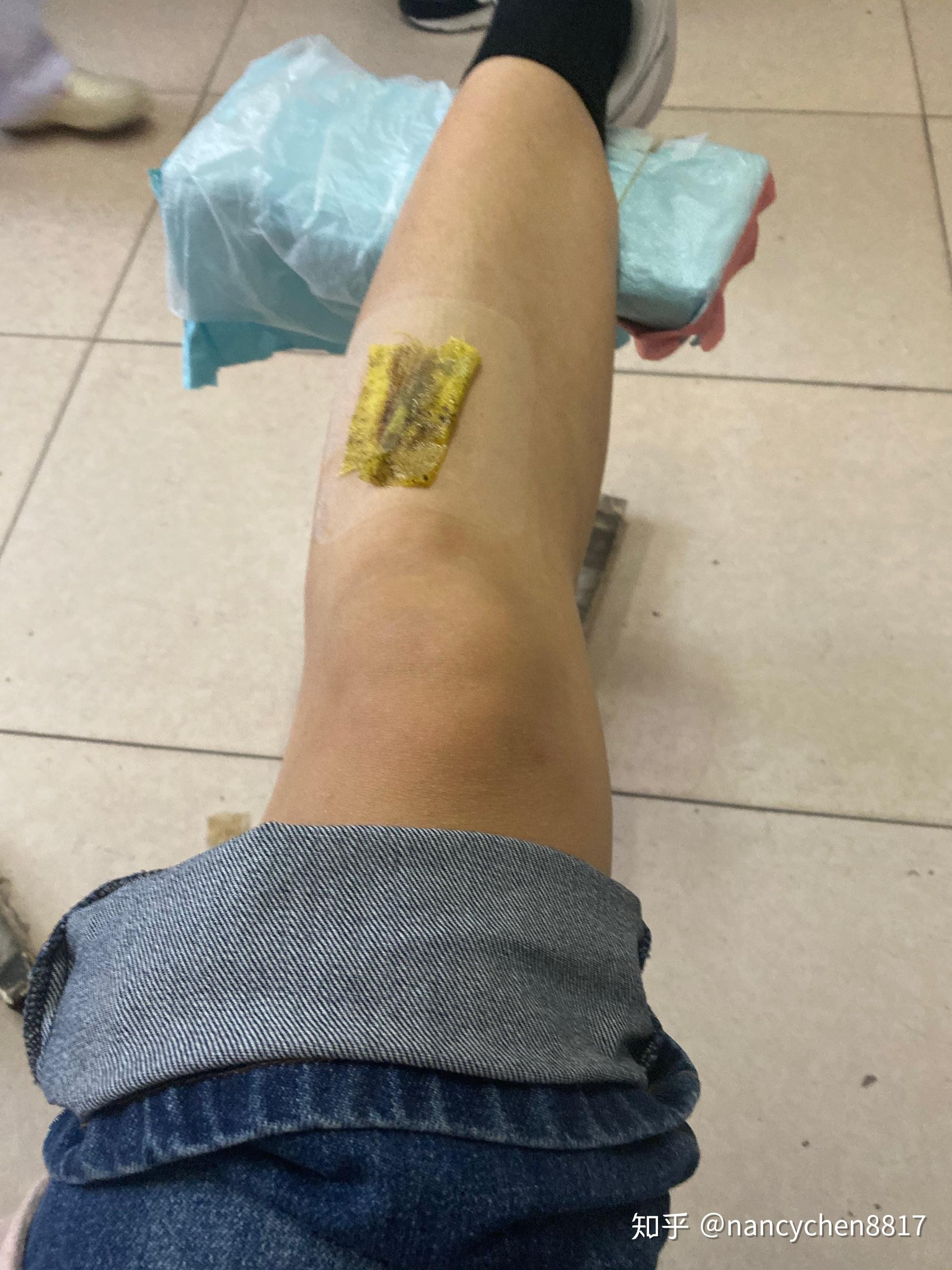 热水袋烫伤后的治疗 - 知乎