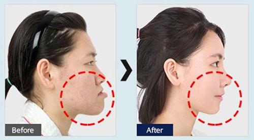下巴往前翘侧面丑的根本原因分析!前突改善要做下巴整形