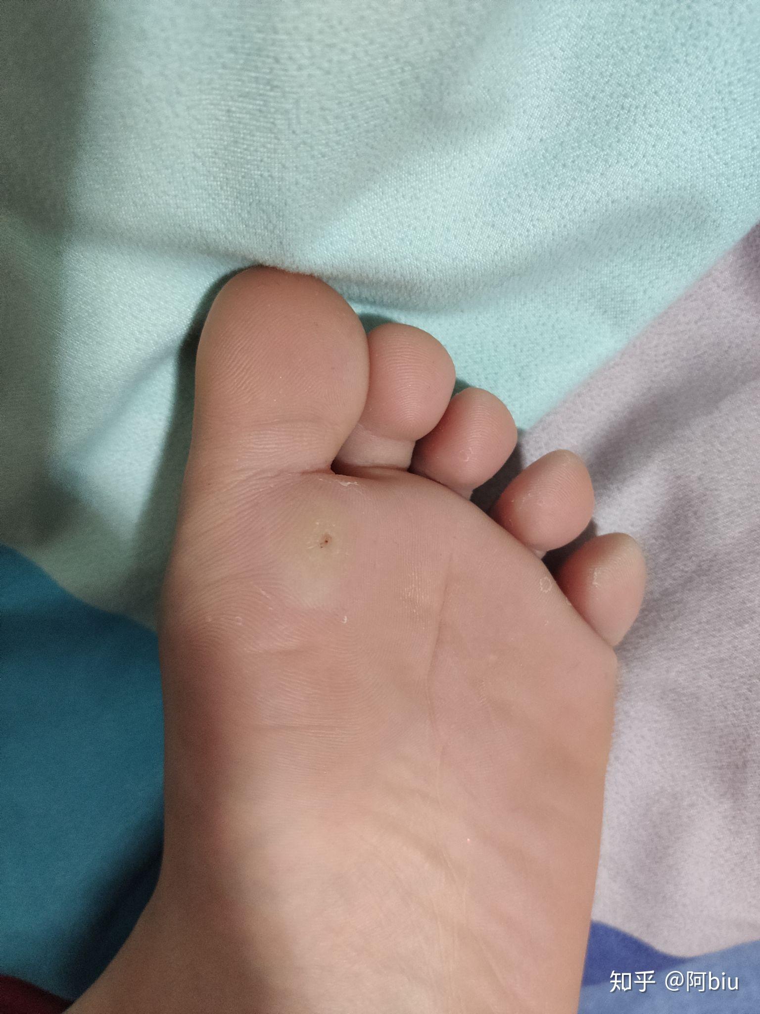 你是如何治好脚上长的鸡眼的