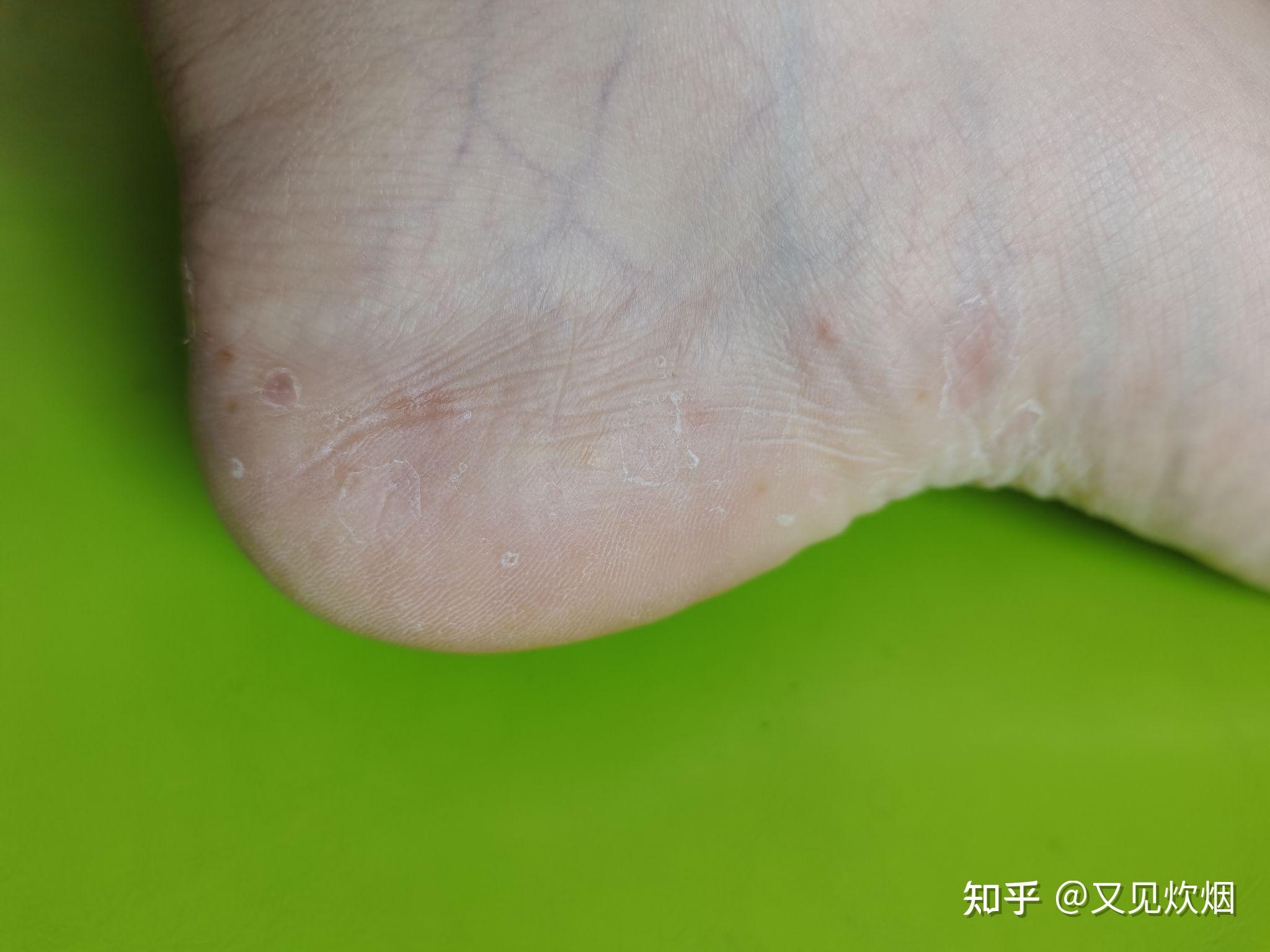 水疱型脚气水泡能扎破吗