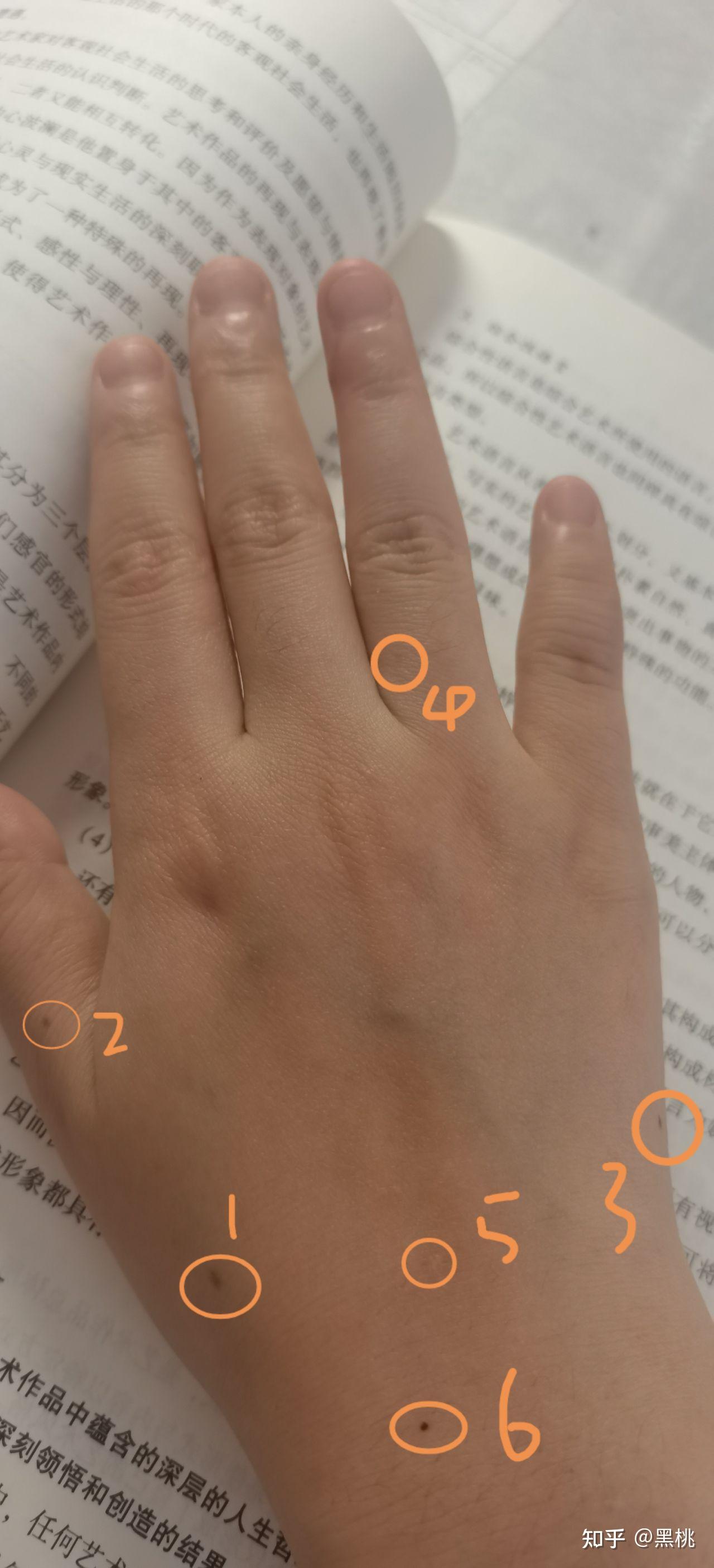 右手背长痣