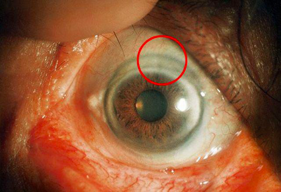 为什么人老了以后眼睛会变得浑浊? - 知乎