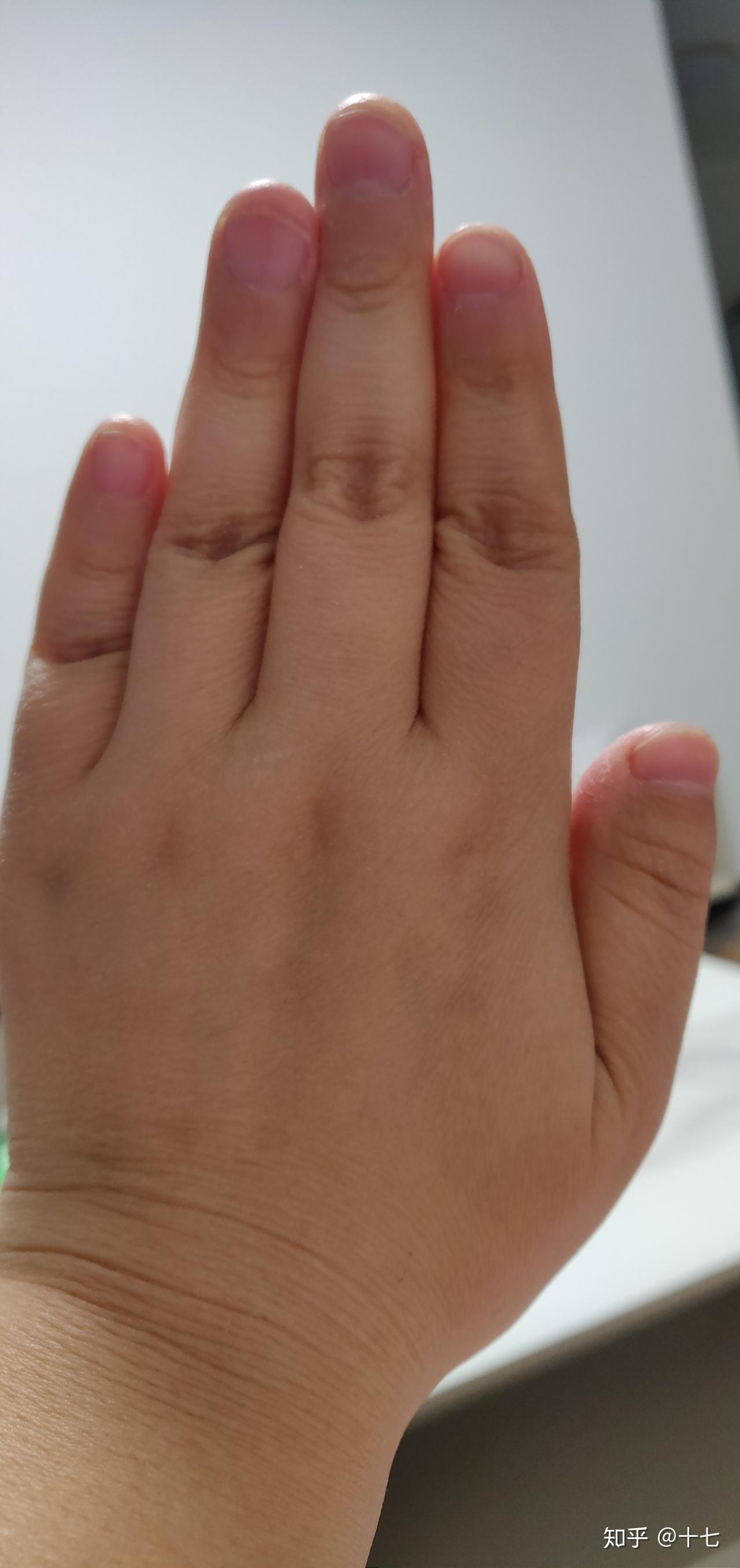 为什么我的大拇指又宽又短? 