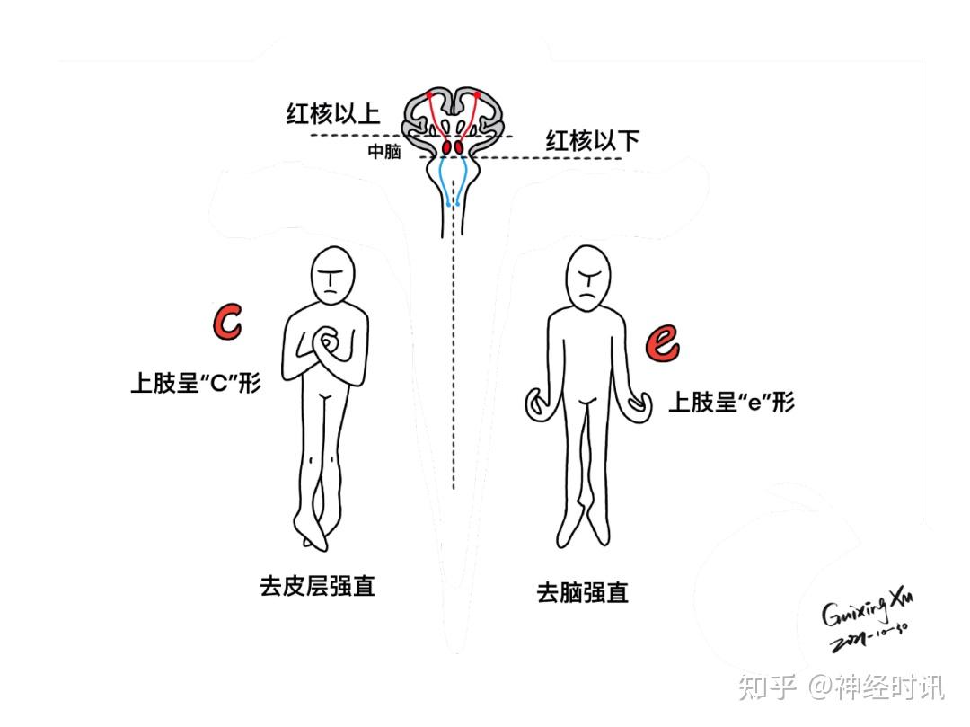 去皮层强直,去脑强直weber(大脑脚)综合征中脑顶盖位置及上丘切面锥体