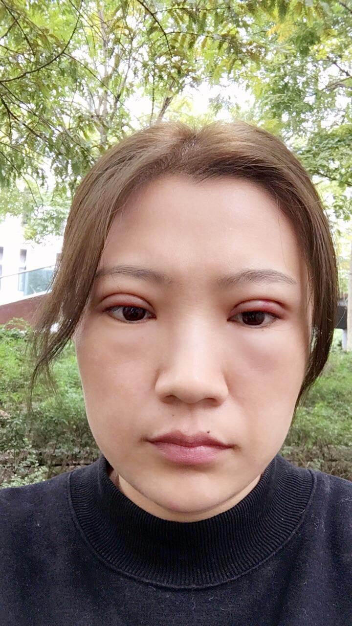 韩式全切双眼皮上睑下垂矫正手术恢复日记