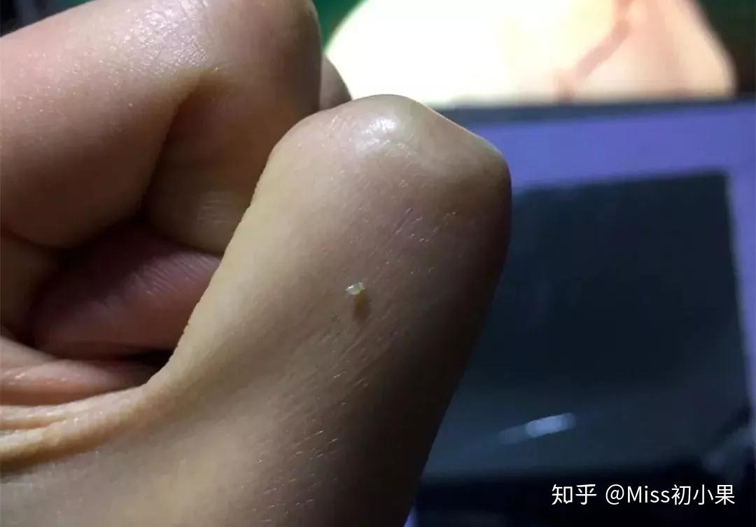 怎么消除眼睛上的脂肪粒