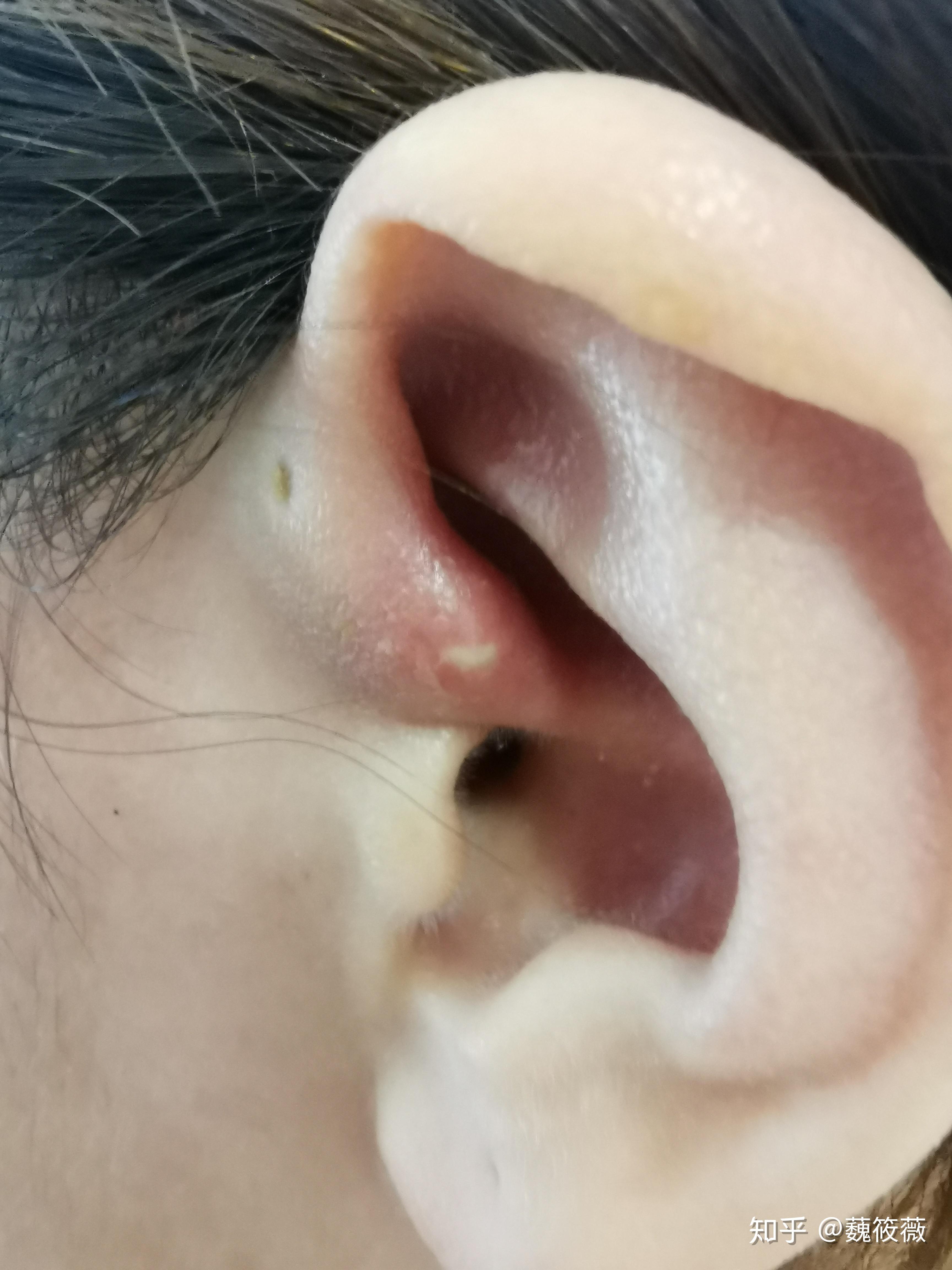 患有先天性耳前瘘管是一种怎样的体验