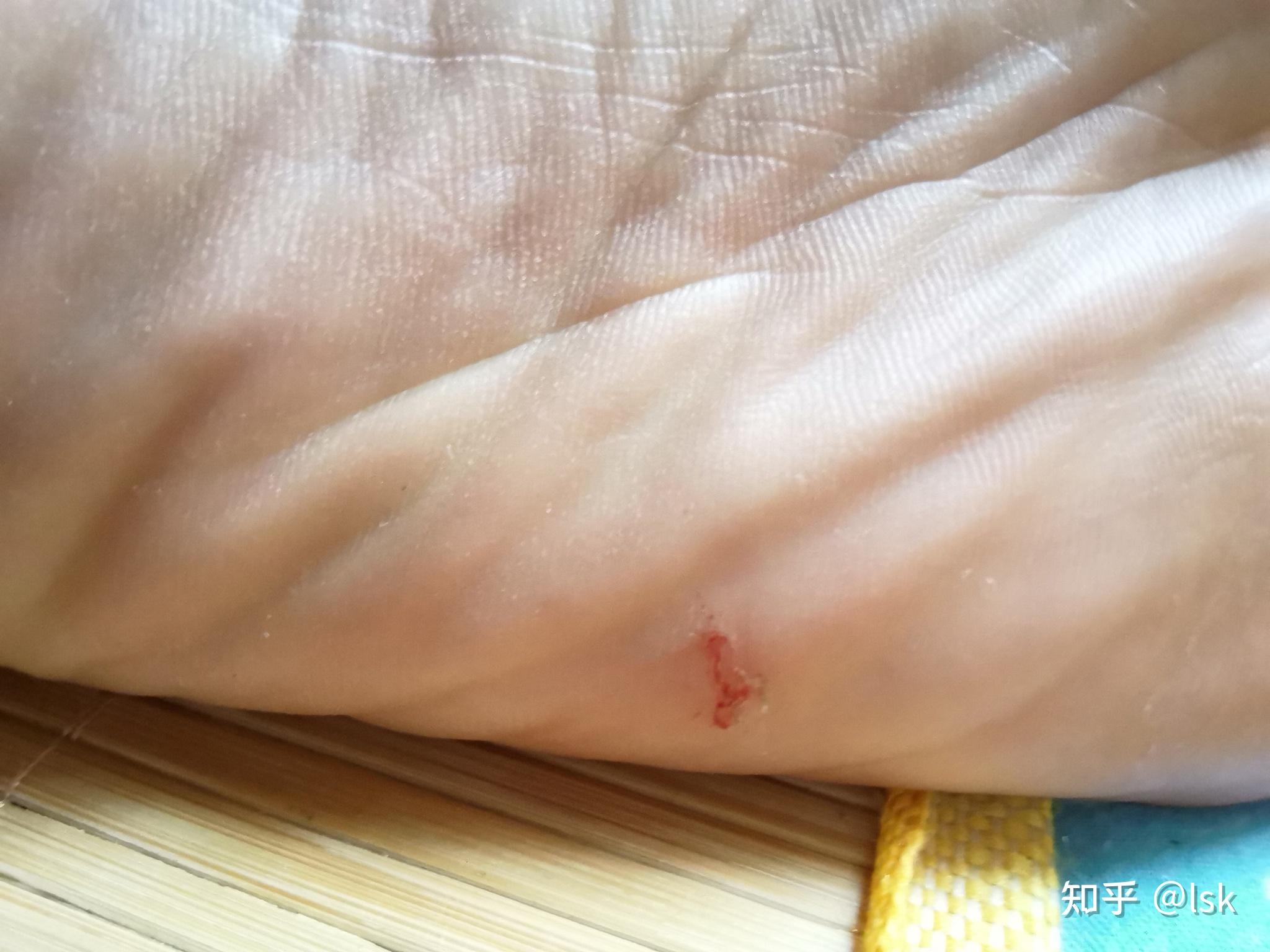 不小心玻璃扎进手里,我把外面可以看见的夹了出来,但是感觉里面还有