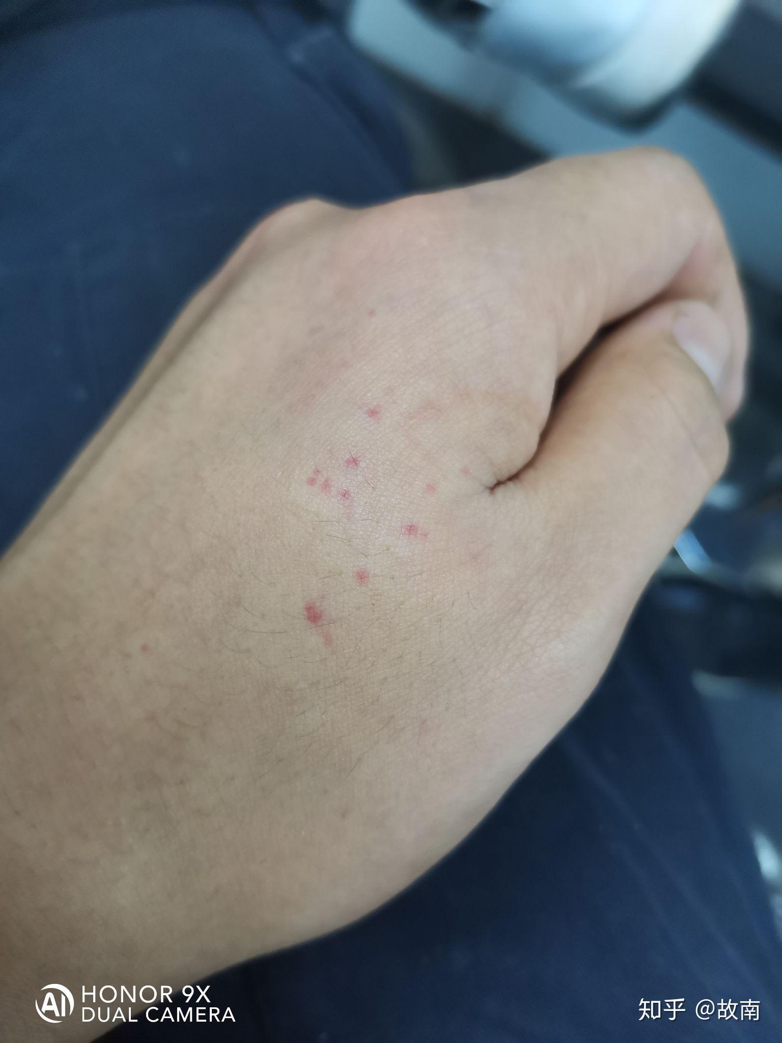 起床以后看见左手虎口上面一点位置起了好几个红点不痛不痒求解答