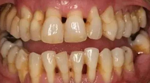 重度牙周炎导致牙齿松动了,一定要拔掉吗?