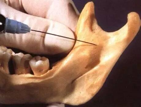 下牙槽神经阻滞麻醉失败的原因