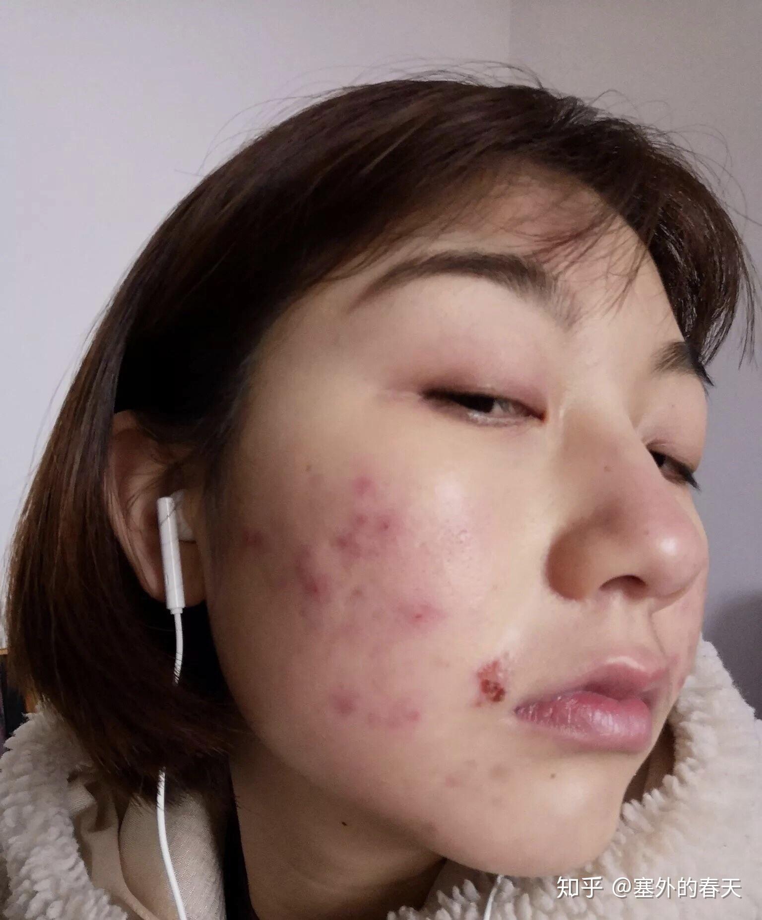 这应该是知乎最专业的祛痘印终结篇附洗面奶怎么选