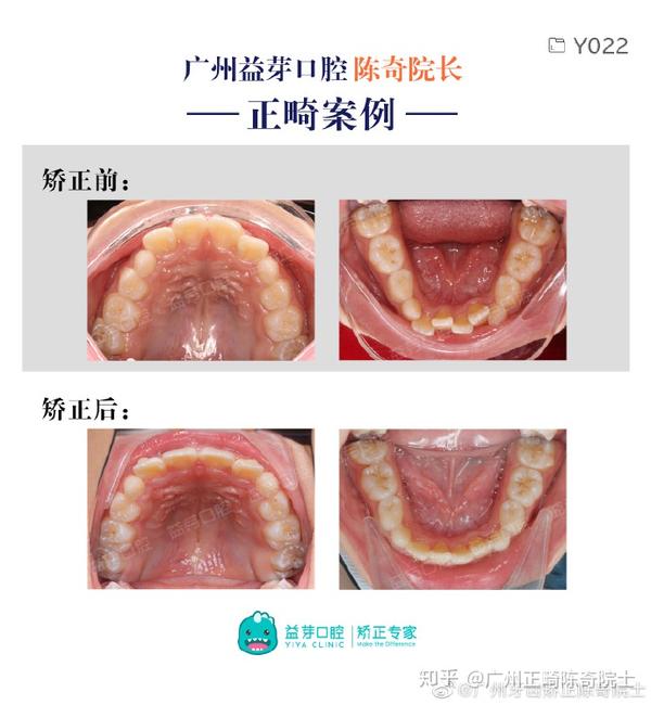 小朋友牙弓狭窄应该怎么办呢?