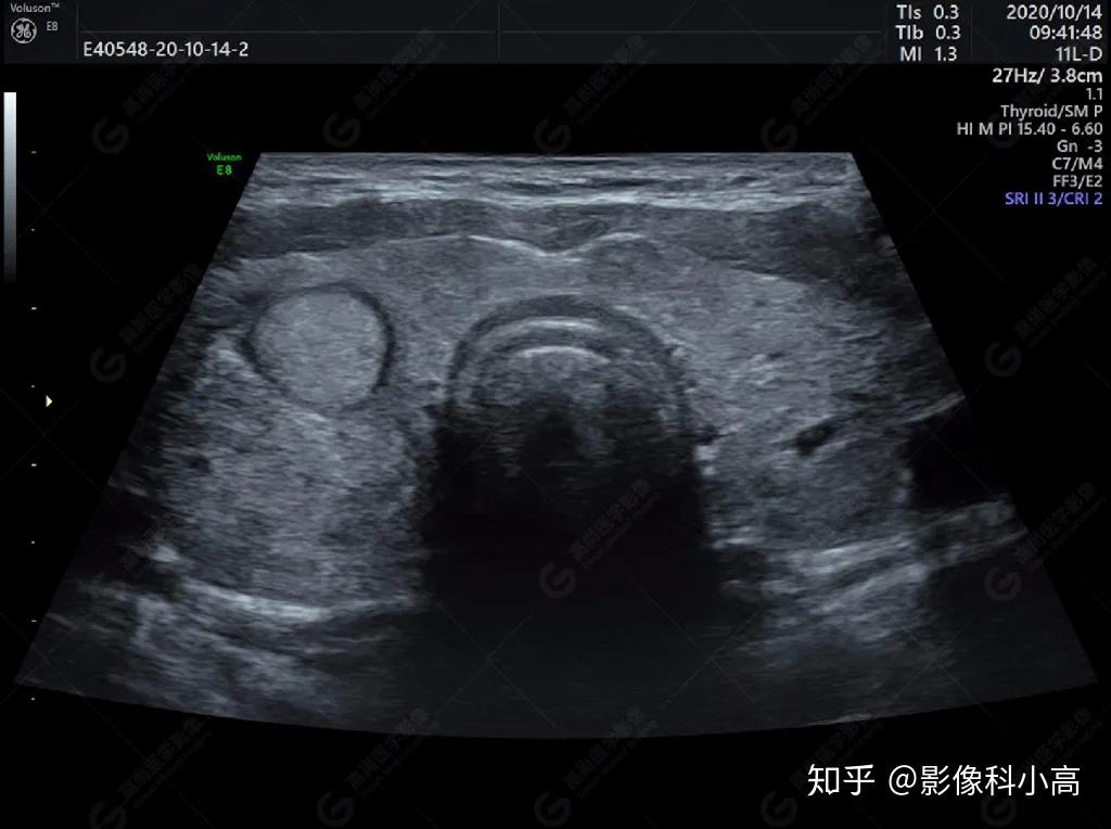 【高尚超声】浅表病例之结节性甲状腺肿