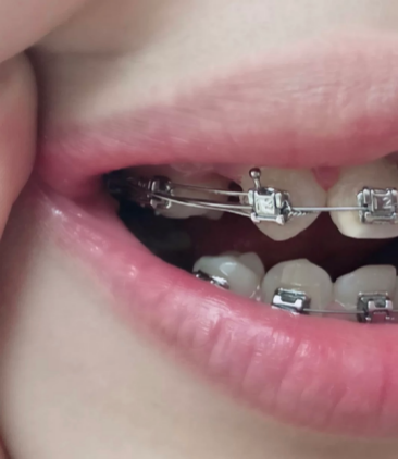 牙齿正畸后怎么不费事地保持口腔卫生呢