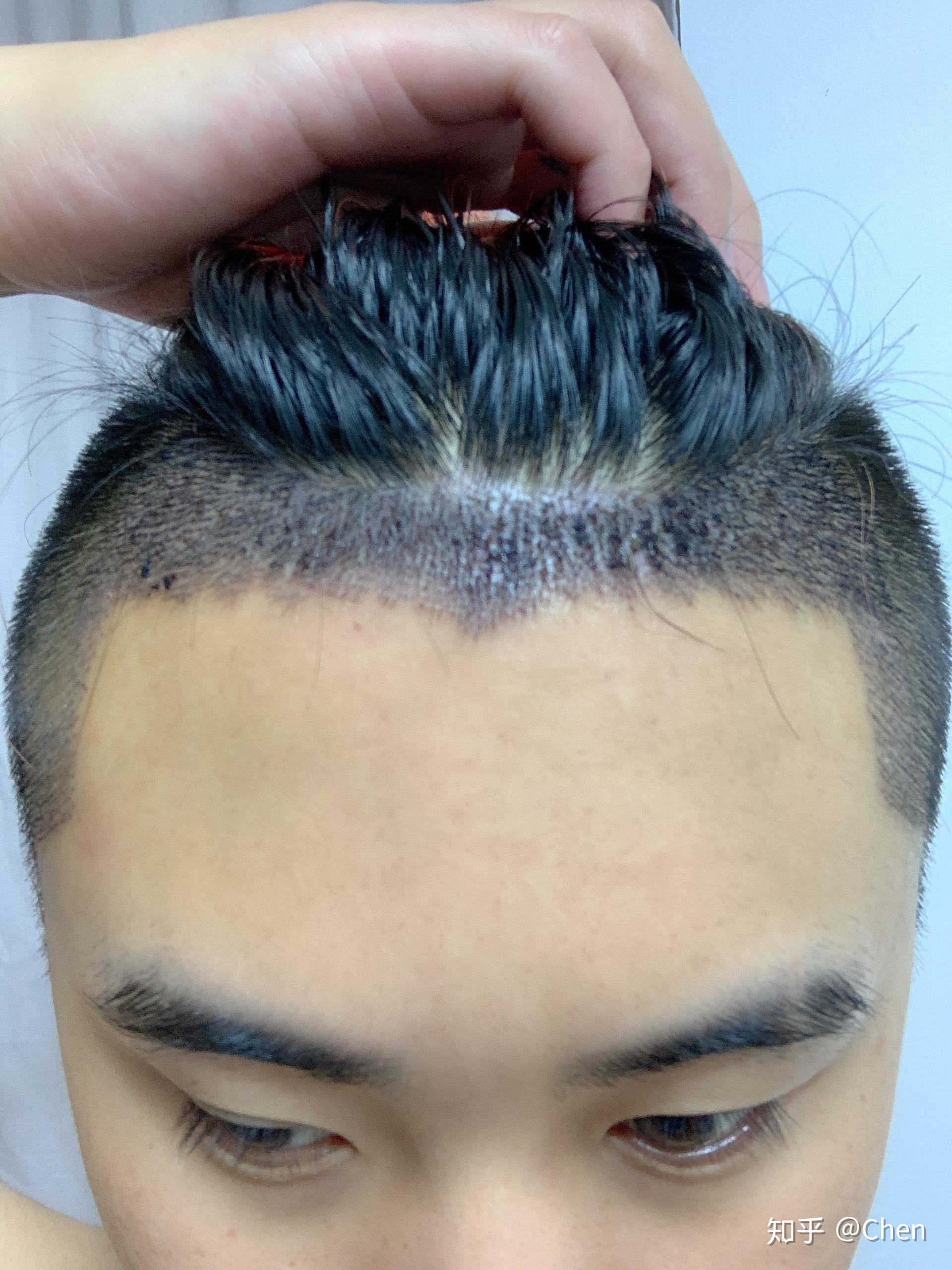 FUE巨量植髮合併醫學生髮讓頭髮逆齡生長