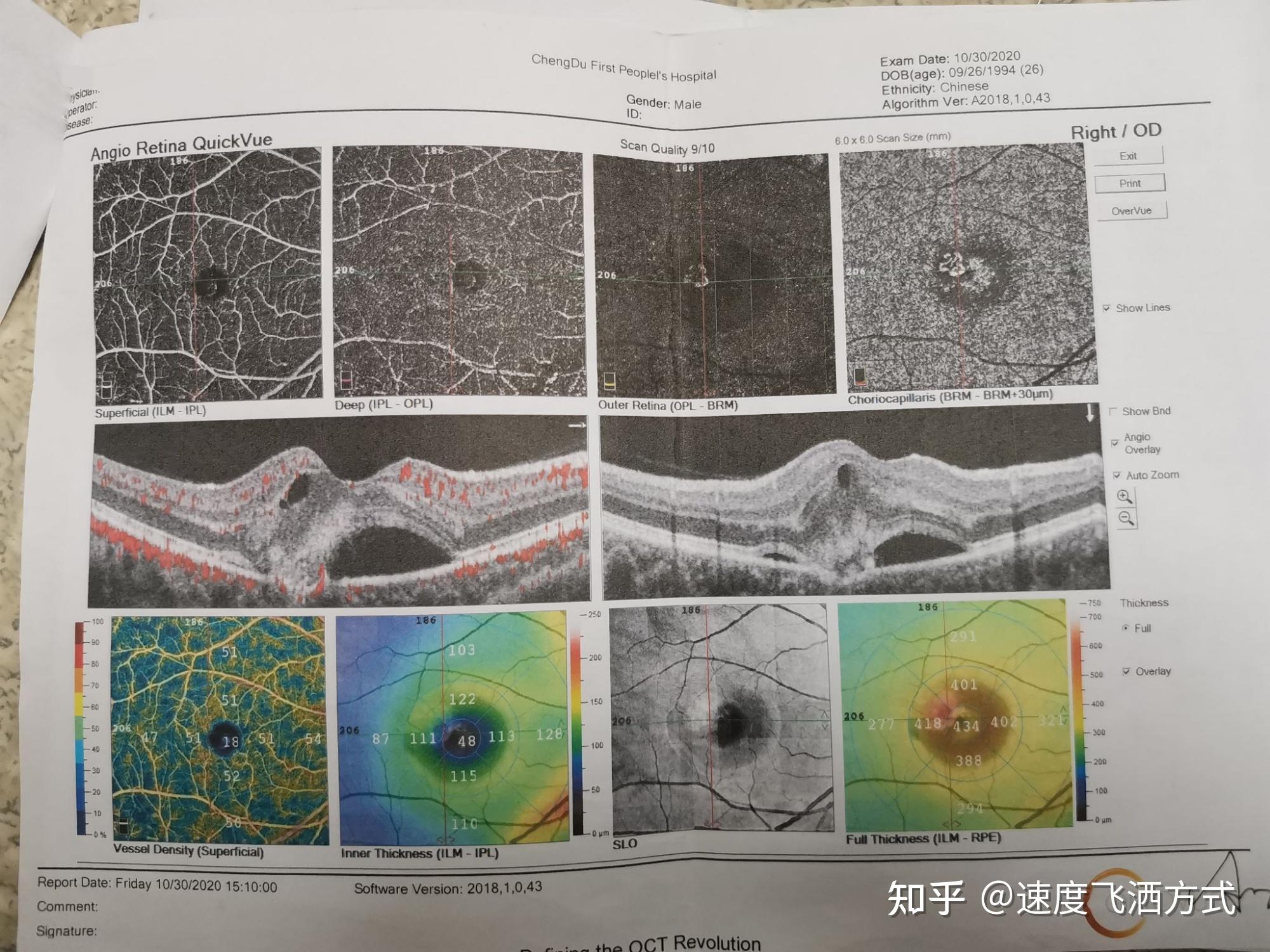 得了脉络膜新生血管(cnv)后大家都做什么工作? - 知乎