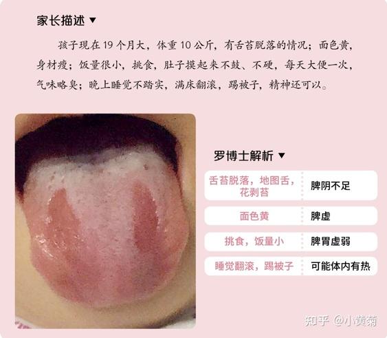(4)孩子缺锌和脾阴虚的症状很相似每个人的舌头上都会有红色的颗粒,像