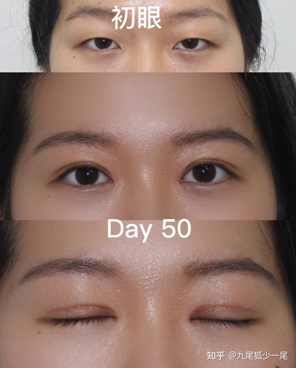 上海王俊芳,范海燕,柴云这些医生做双眼皮技术怎么样?整体效果自然吗?