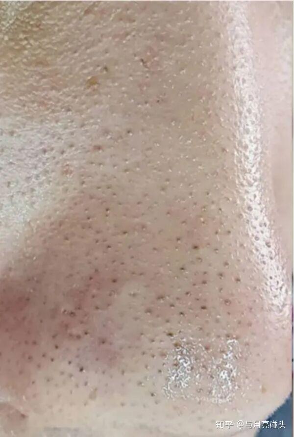 脂质微丝?角栓?黑头?