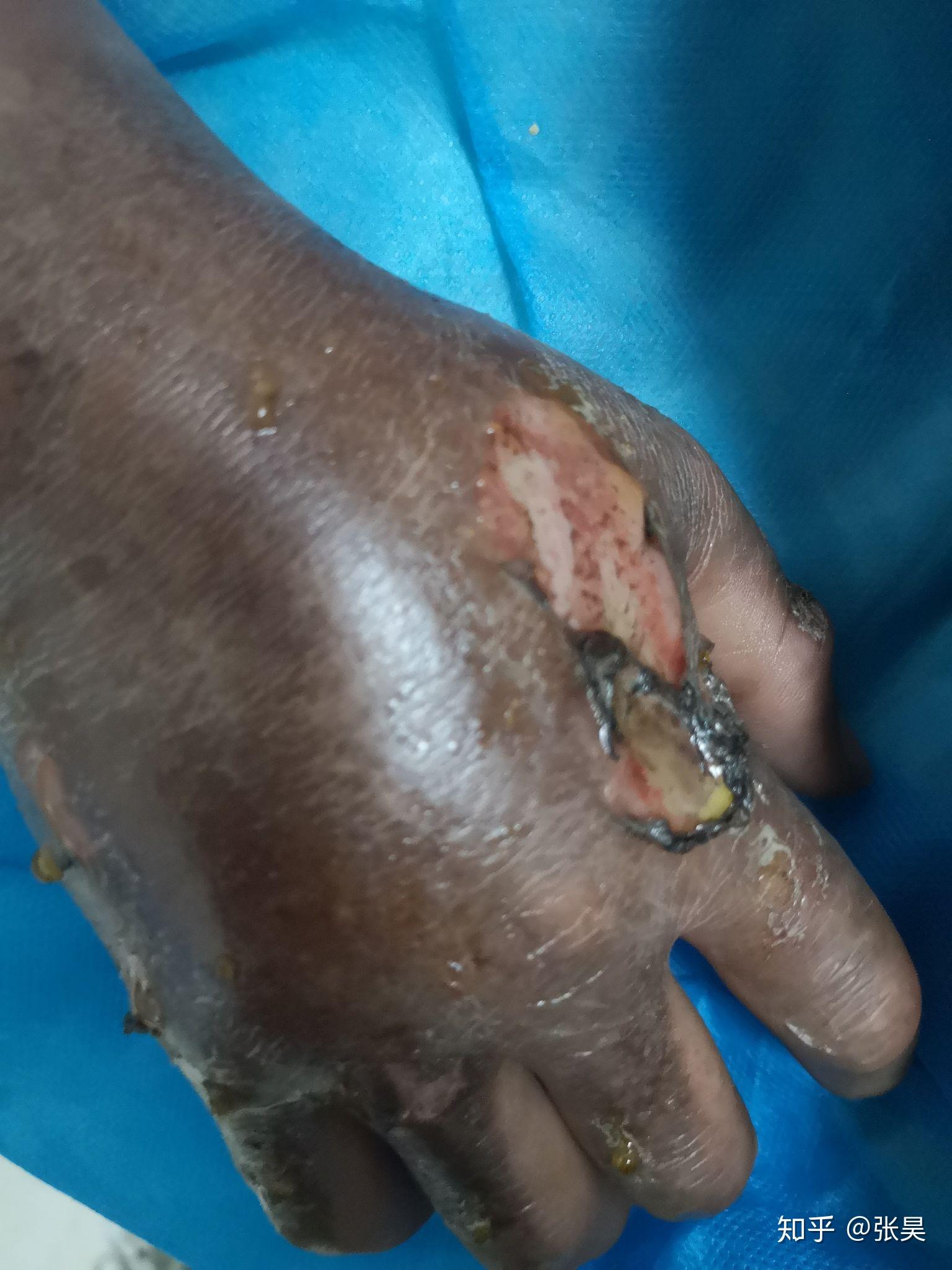 高压电击会瞬间死亡吗? - 知乎