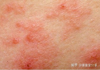 身上起红疙瘩越挠越痒可能是这9种皮肤病
