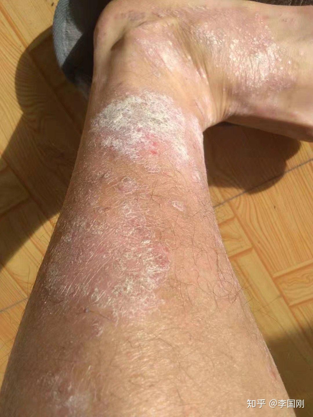 腿部直接消退顺序图片黑龙江齐齐哈尔