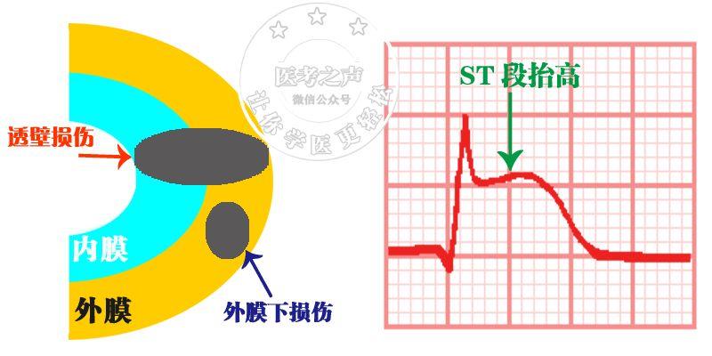 推理:這個抬高的機制目前還不完全清楚通常認為與損傷電流有關上面說