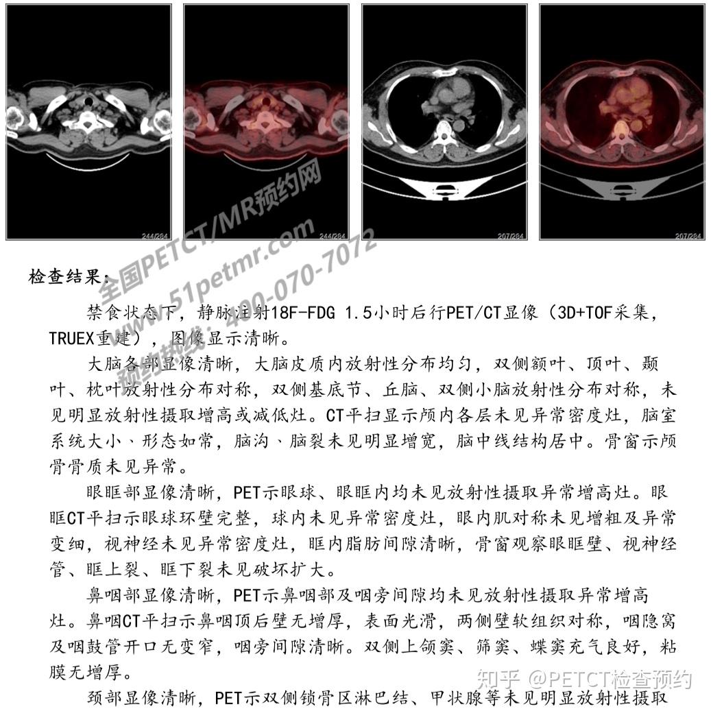 高端体检癌症筛查PETCT检查案例-全国PETCT/MR（核磁）检查预约网 - 知乎