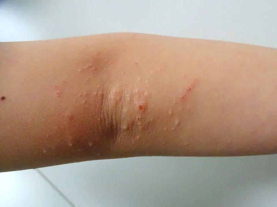 又叫婴儿苔藓样皮疹,主要是由乙型肝炎病毒通过皮肤黏膜所致的原发性