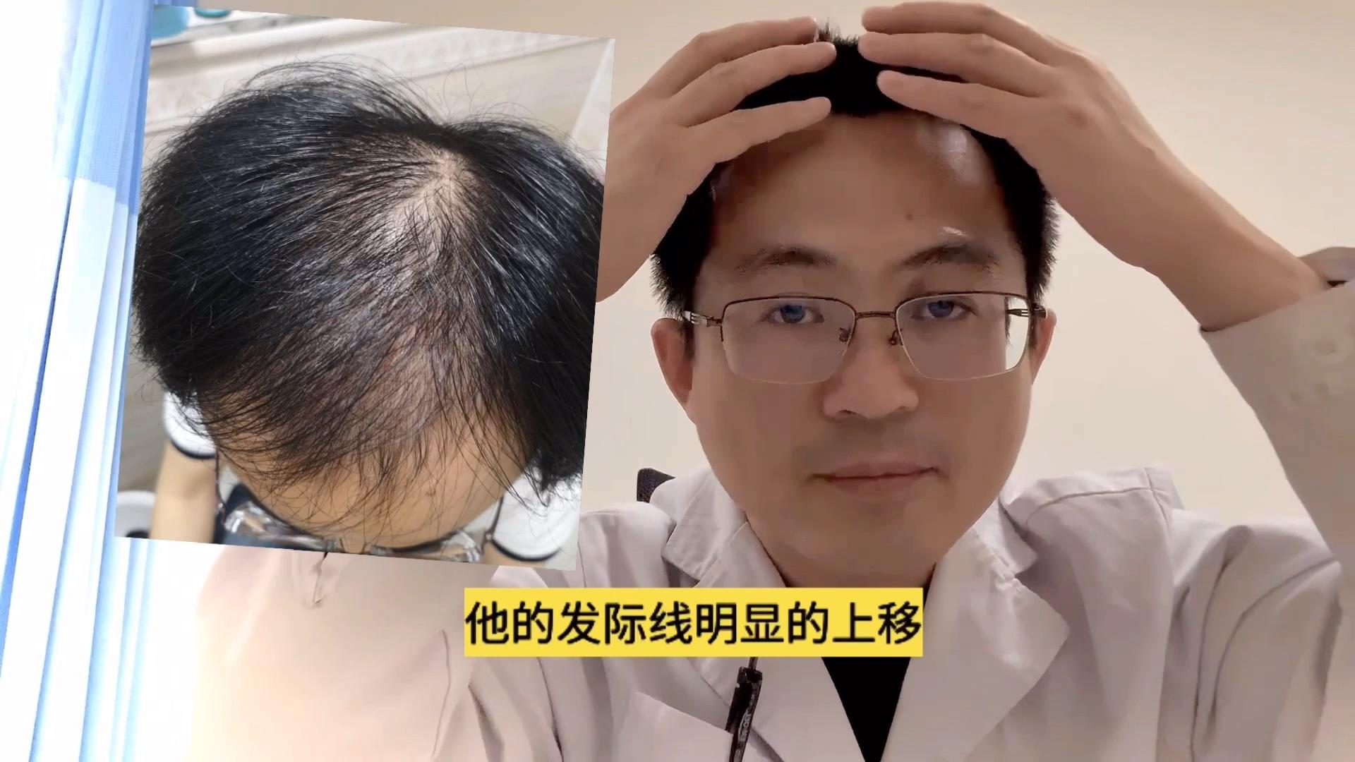 男女雄性激素过多怎么办    脱发秃顶多囊该怎么医治-备孕期男女吃什么生男孩