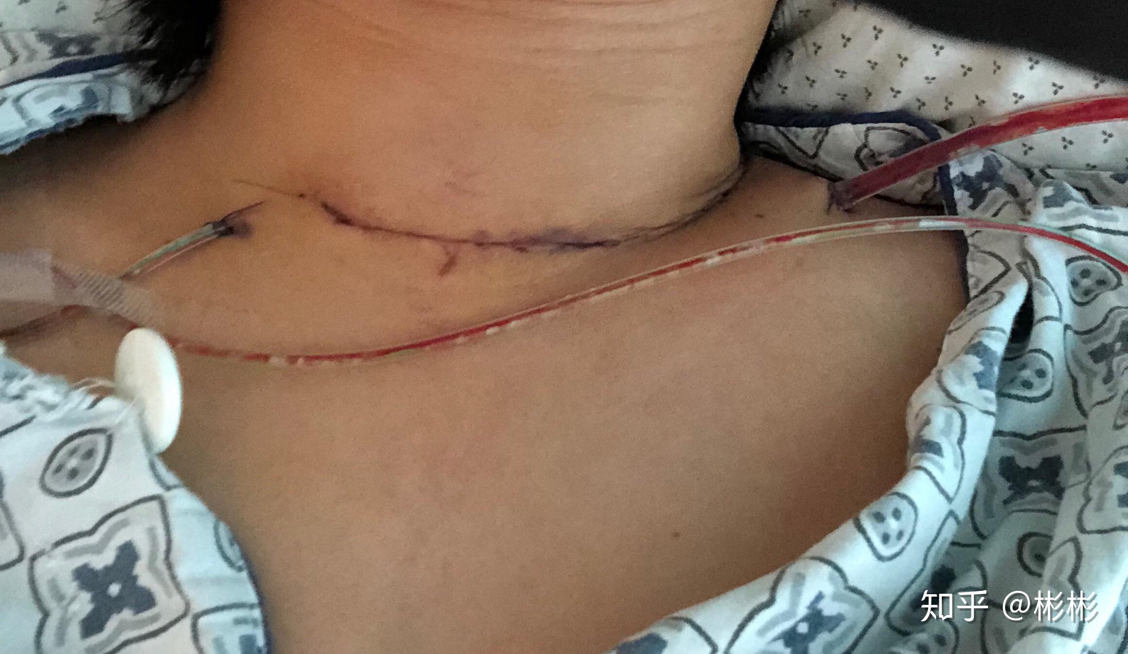 甲状腺手术后