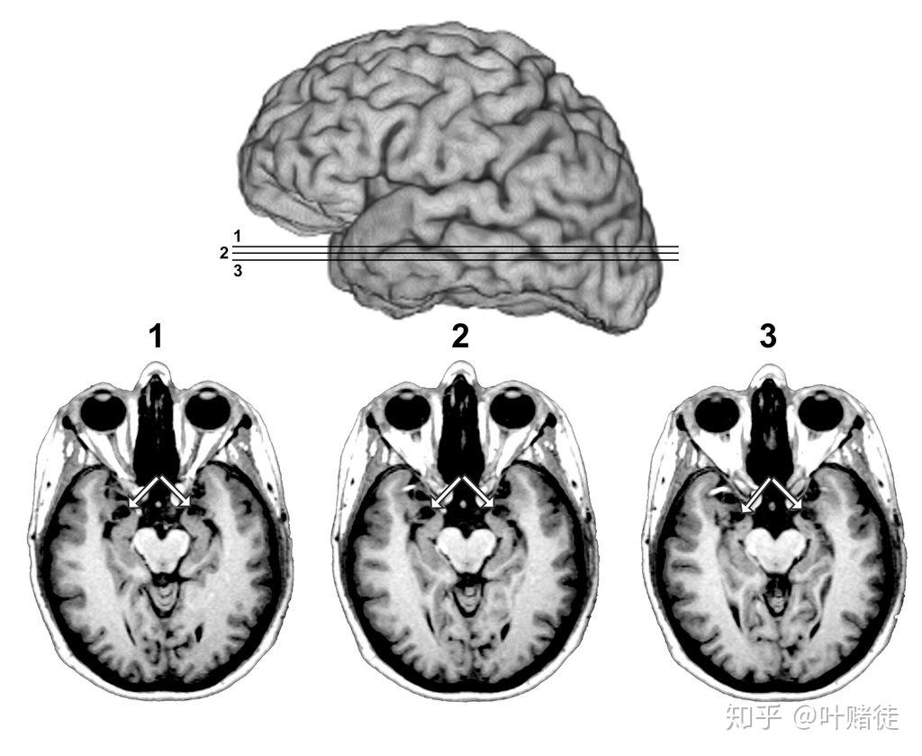 如果杏仁核缺失会怎么样？ - 知乎