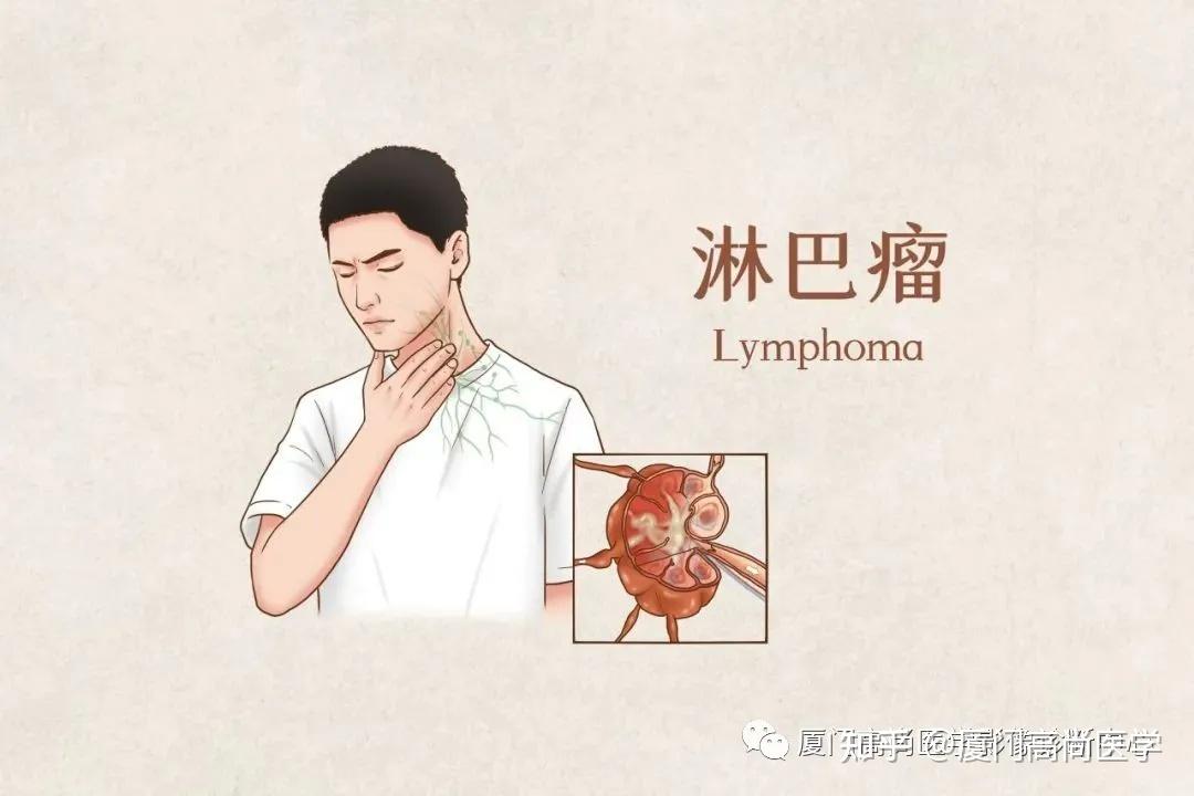 淋巴瘤我们有petct