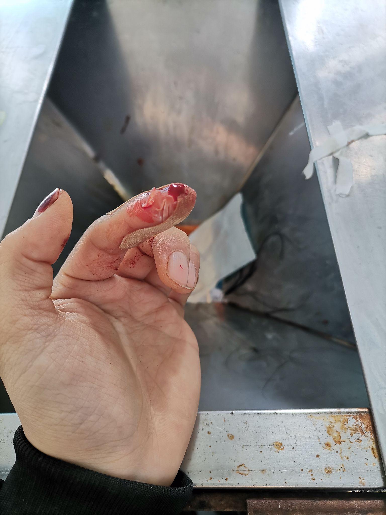 手指切断了还能康复吗? - 知乎