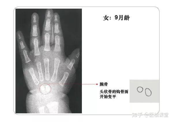 超详细骨龄图谱（收藏） - 知乎