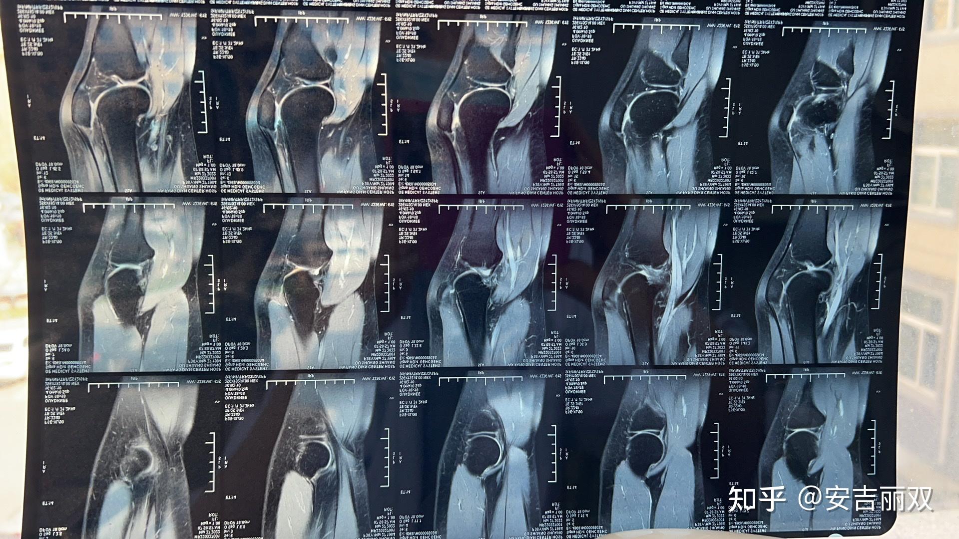 半月板损伤保守治疗纪录 - 知乎