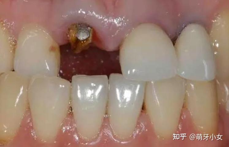 牙根断成什么程度无法保留? - 知乎