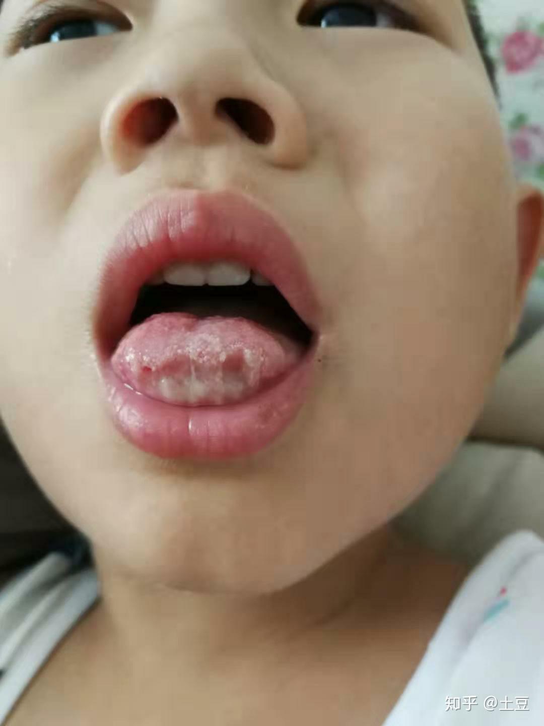 别敏口腔溃疡含漱液-Biminne:别敏牙膏中国官网