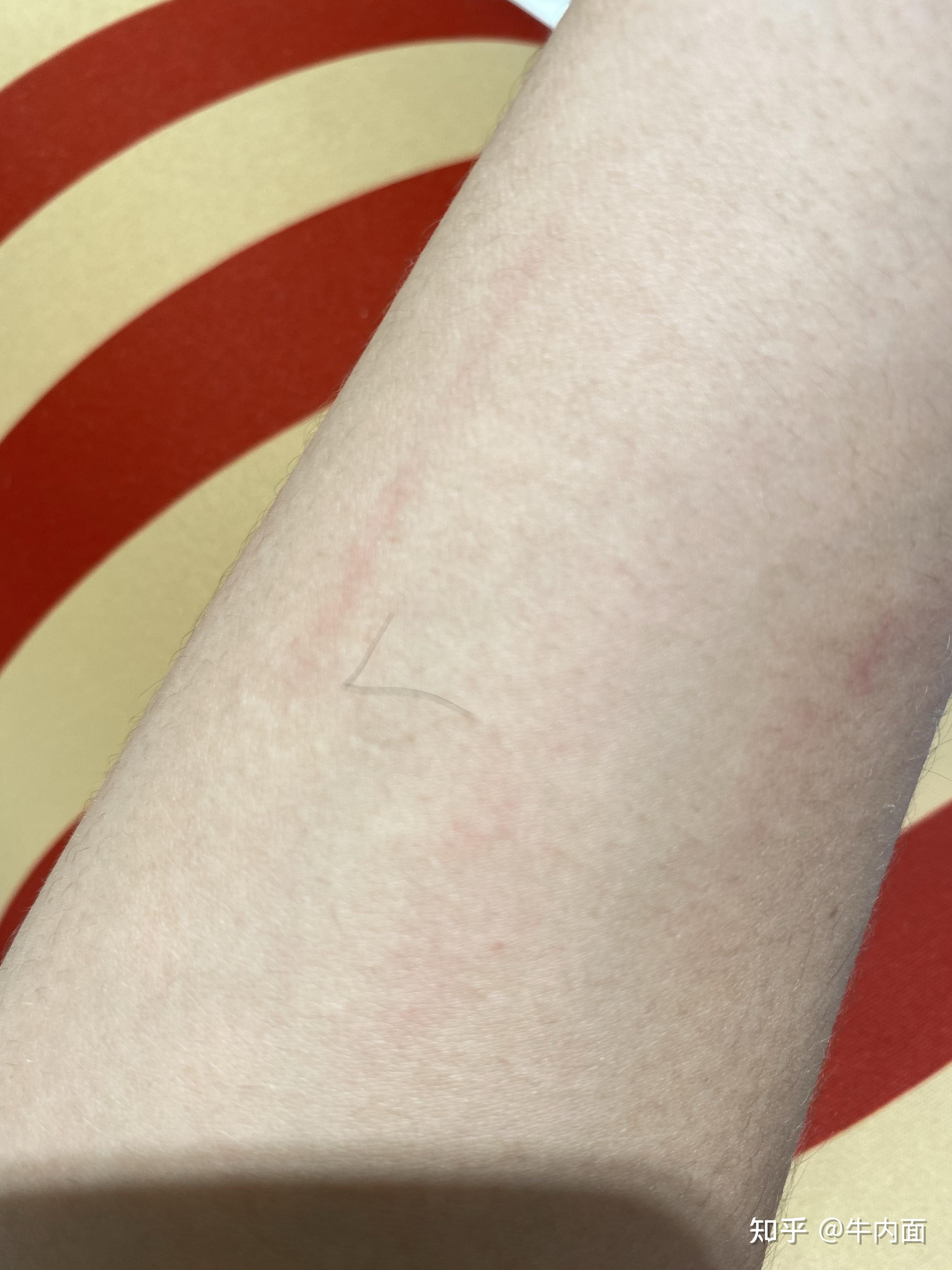 为什么手臂上会长出一根特别长的毛