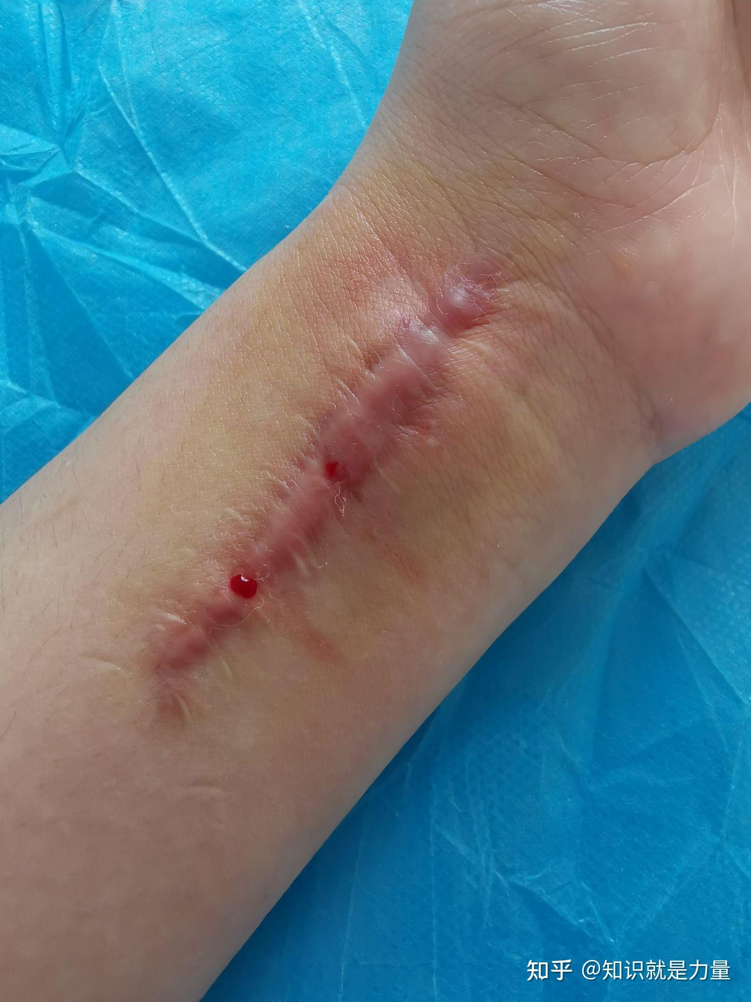 第二次疤痕针治疗