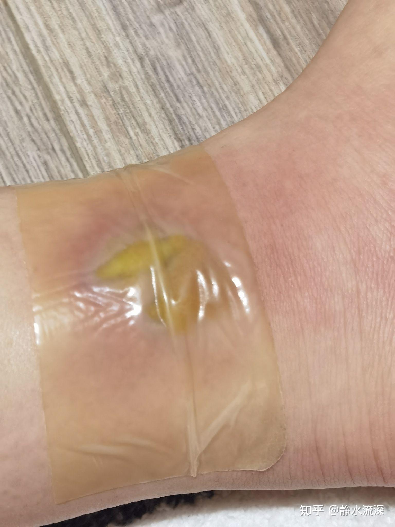 热水袋低温烫伤记录图片