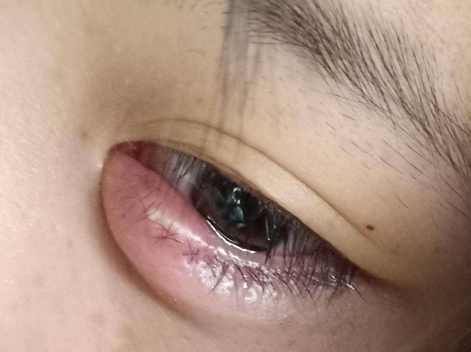 长针眼是一种什么体验