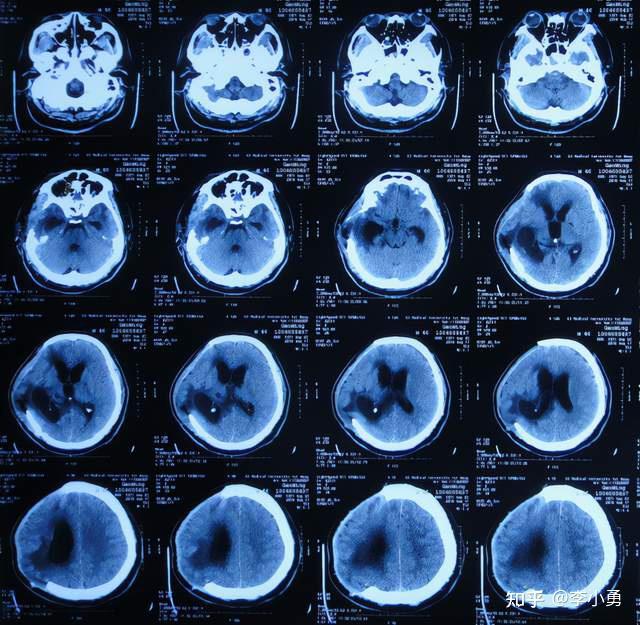 腦外傷治1年半仍無效腦積水腦膨出先後行腦室腹腔分流術電子腦室鏡術