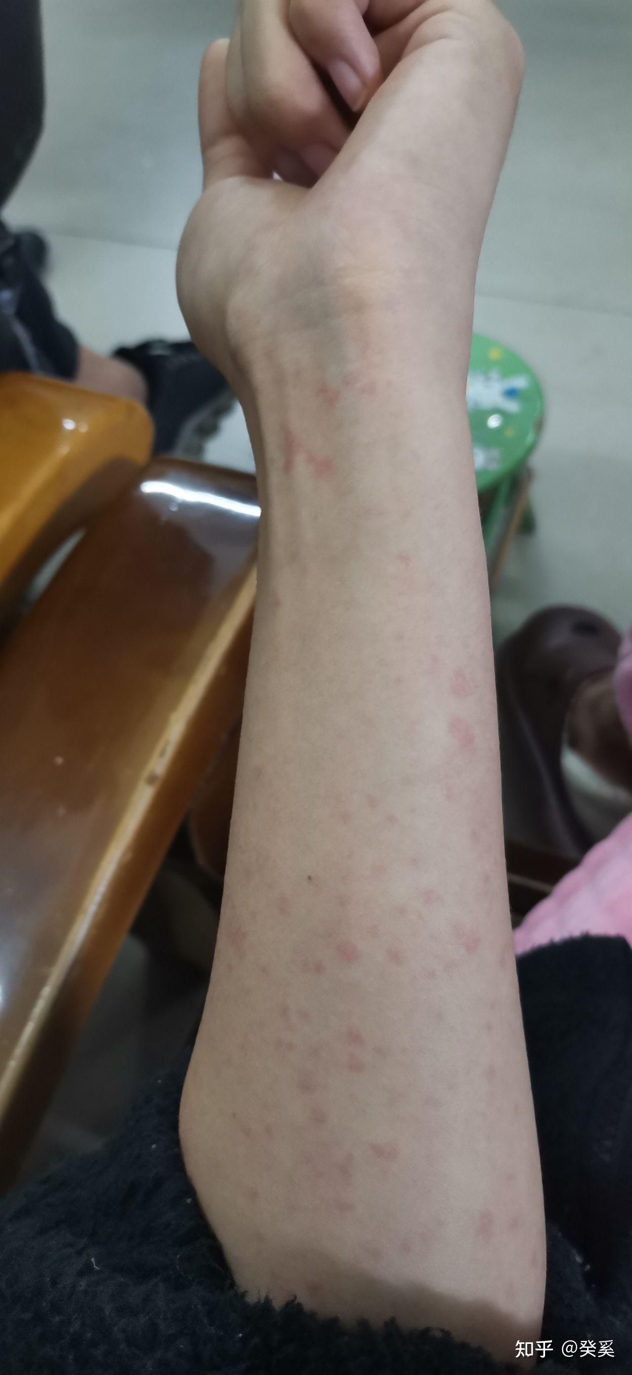  疫情一般是什么症状啊(疫情是些什么症状)