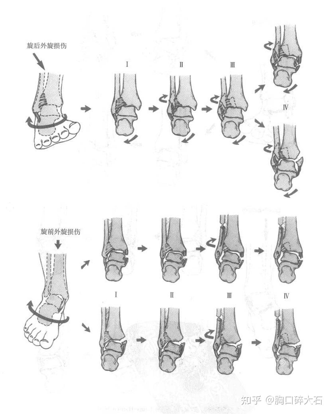高位踝关节扭伤和韧带联合损伤
