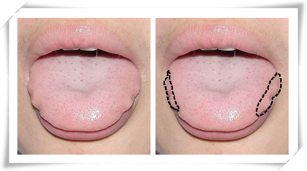 增生舌与胖大舌的区别