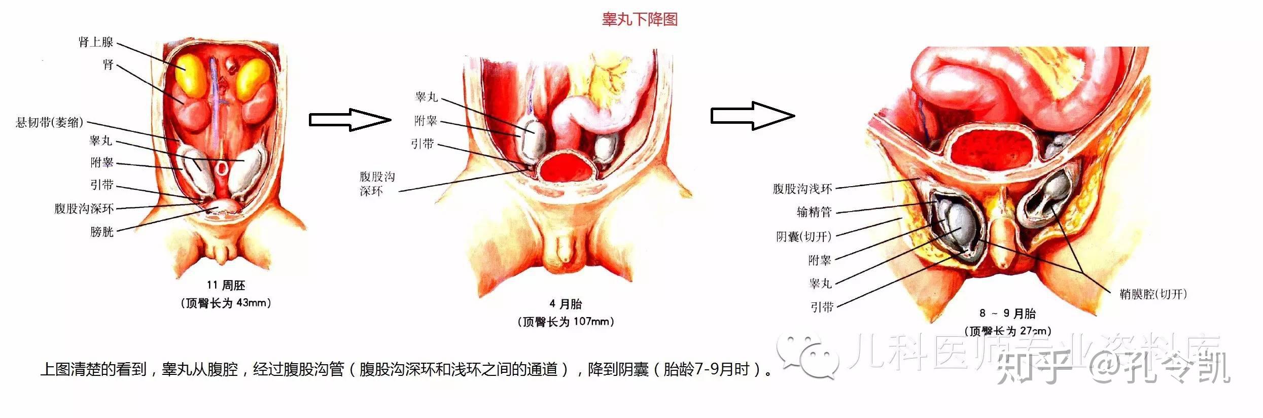 附睾囊肿误诊为精索鞘膜积液一例