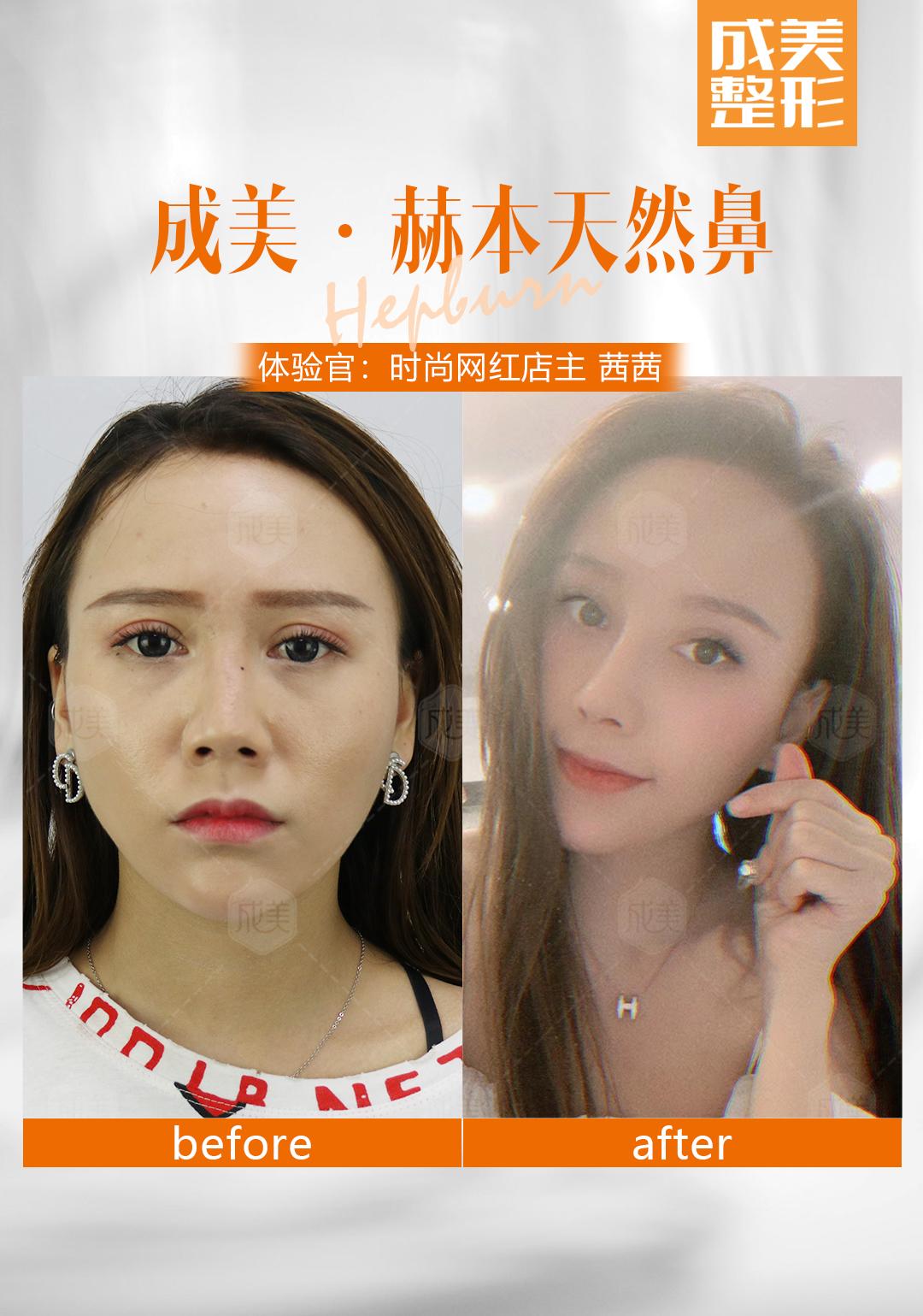隆鼻后鼻尖红肿 是不是隆鼻失败了 知乎 隆鼻后鼻尖红肿 是不是隆鼻失败了 知乎